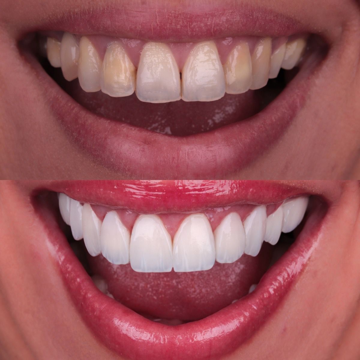 Antes e depois — Caso resolvido em 2 sessões.
